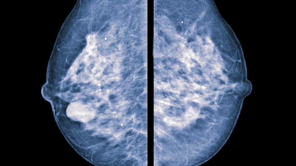 mammary imaging screening picture