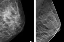 Mammography pictures