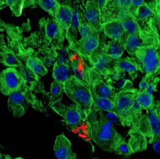 Microscopy picture of lung tumor cells